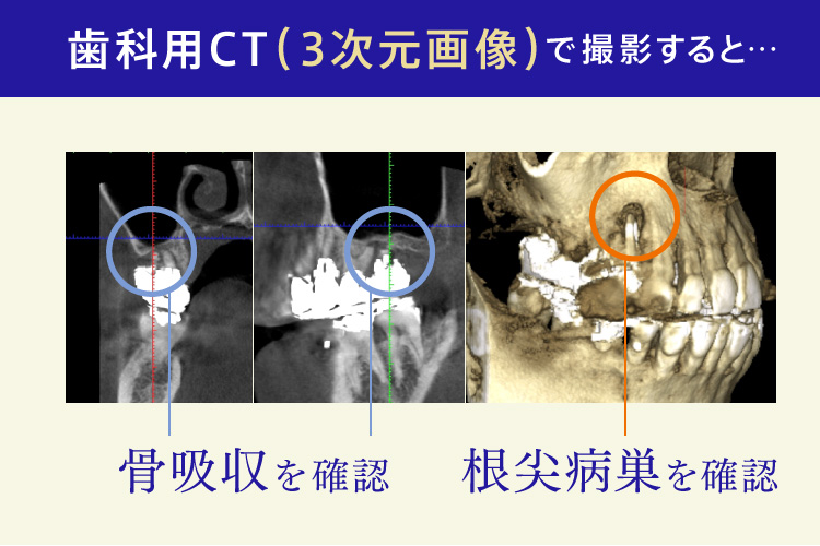 歯科用CT（3次元画像）で撮影