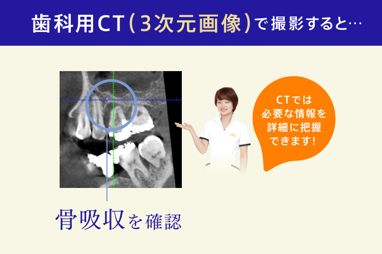 歯科用CT（3次元画像）で撮影