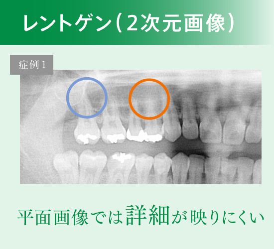 レントゲン（2次元画像）