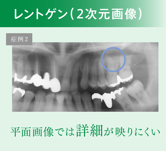 レントゲン（2次元画像）