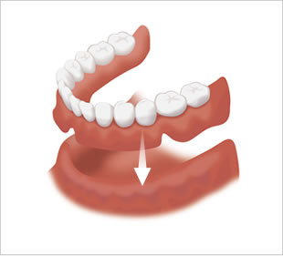 総入れ歯をかぶせると