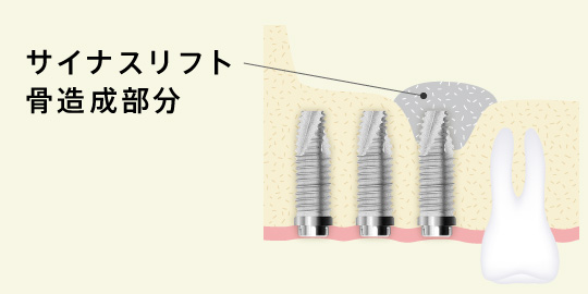 サイナスリフト骨造成部分