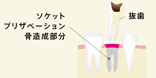 ソケットプリザベーション骨造成部分、抜歯