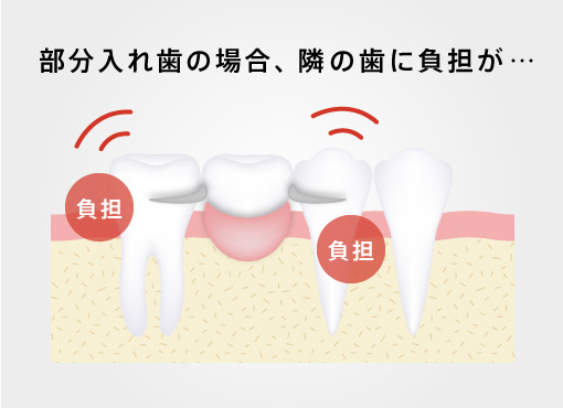 部分入れ歯の場合、隣の歯に負担が…