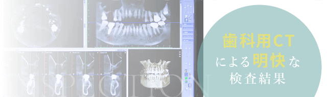 歯科用CTによる明快な検査結果